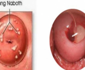 Nang naboth tử cung là gì? có nguy hiểm không?