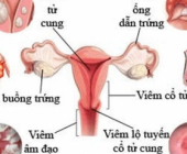 Vùng kín bị ngứa và có dịch trắng là dấu hiệu bệnh gì?