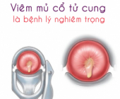 Viêm mủ cổ tử cung và những điều bạn cần biết