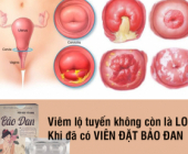 Điều trị viêm lộ tuyến cổ tử cung tận gốc bằng đông y