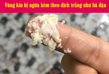 Thuốc chữa vùng kín bị ngứa kèm theo dịch trắng như bã đậu