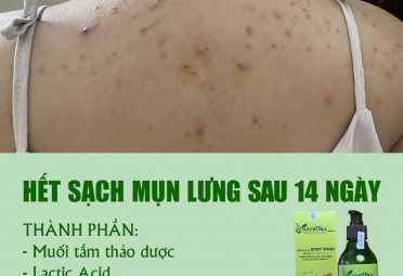 Tại sao sữa tắm thảo dược naurora trị hết mụn lưng?