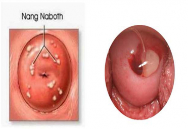 Nang naboth tử cung là gì? có nguy hiểm không?