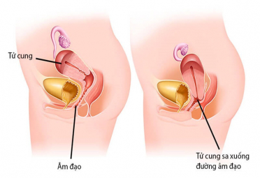 Sa âm đạo là gì? nguyên nhân và phương pháp chữa