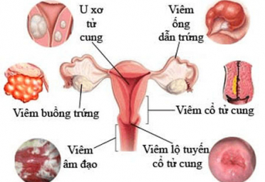 Kinh nguyệt ra máu đông là dấu hiệu của bệnh phụ khoa gì?