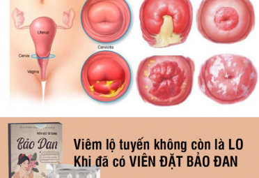 Điều trị viêm lộ tuyến cổ tử cung tận gốc bằng đông y