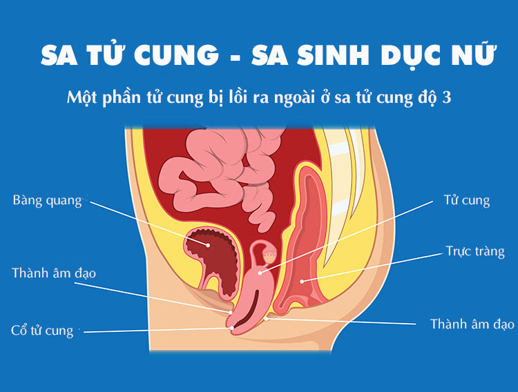 vùng kín có cục thịt lòi ra là sa tử cung