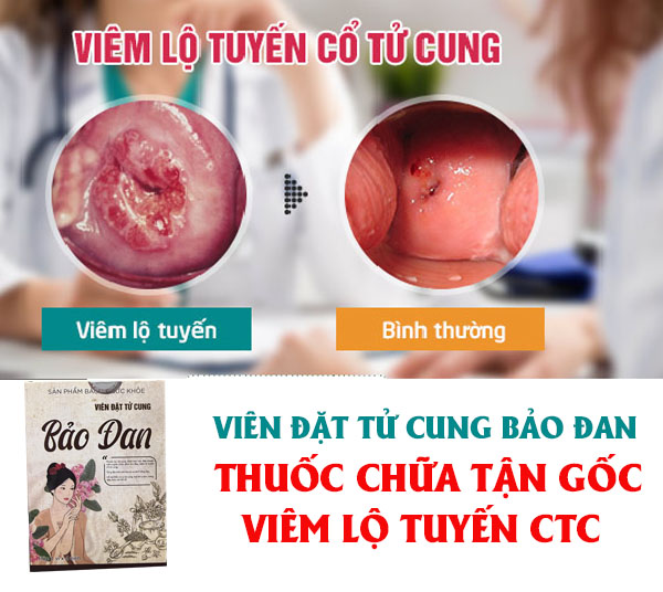 thuốc chữa viêm lộ tuyến nặng