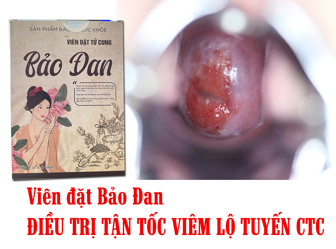 thuốc điều trị viêm lộ tuyến