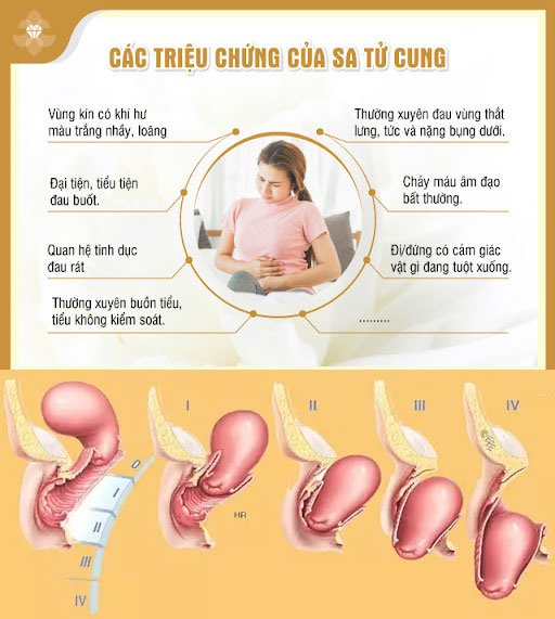 sa tử cung