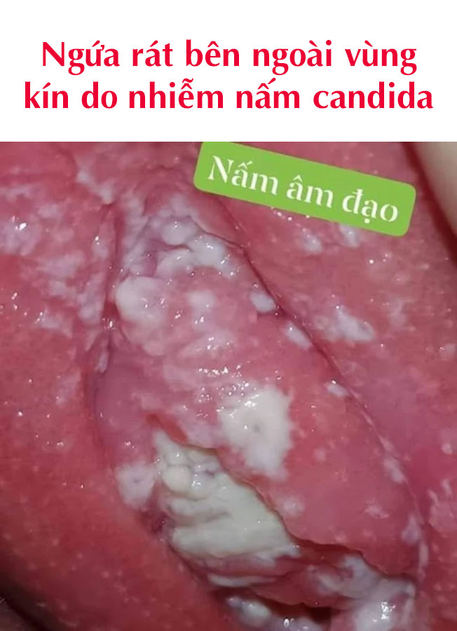 ngứa vùng kín do nấm candida