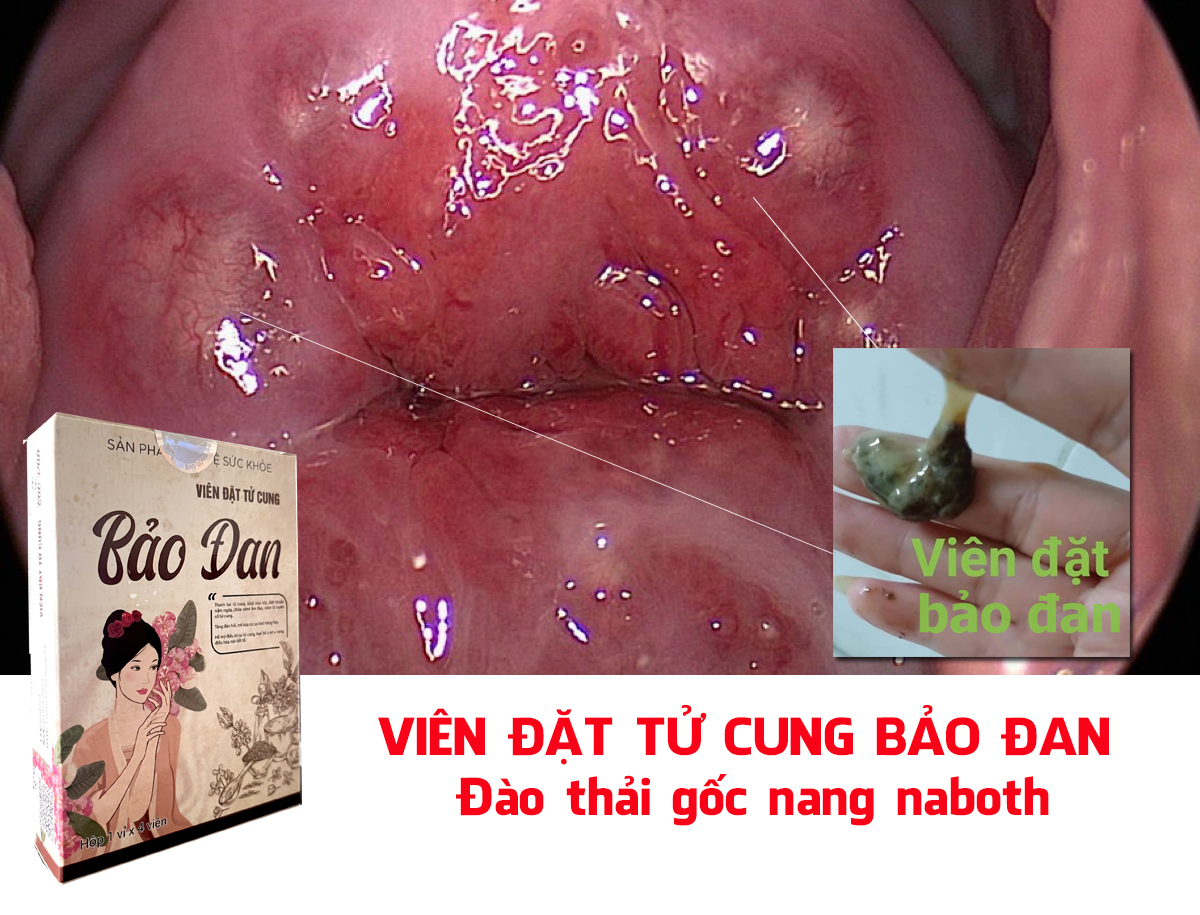 nang naboth tử cung