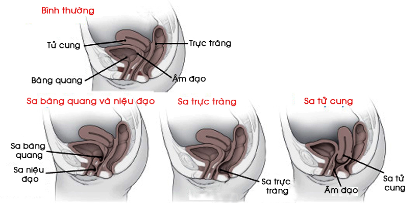 sa tử cung