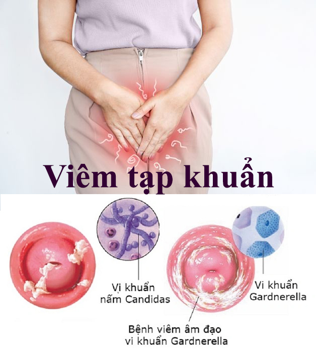 sưng ngứa hột le do vi khuẩn