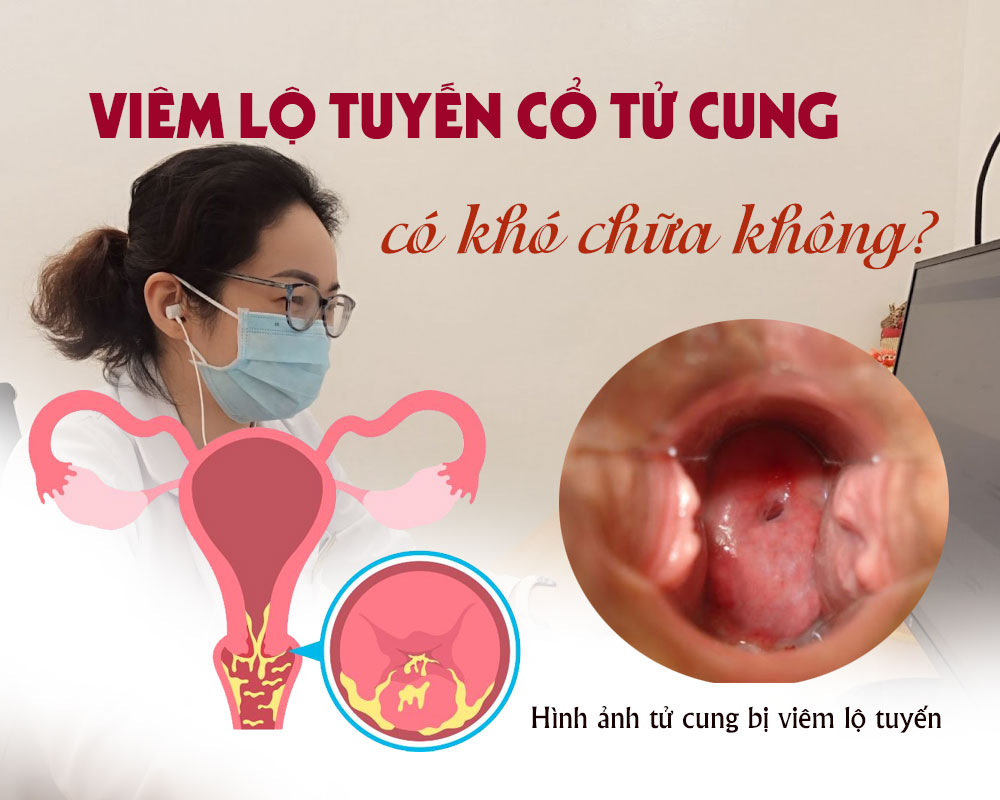 viêm lộ tuyến nặng