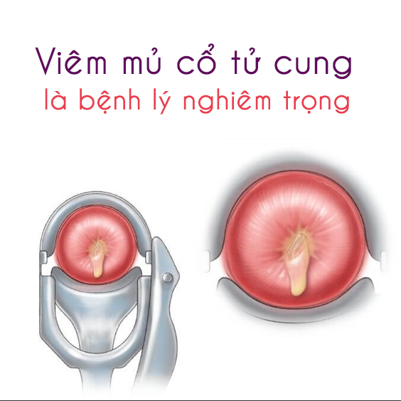 viêm mủ cổ tử cung