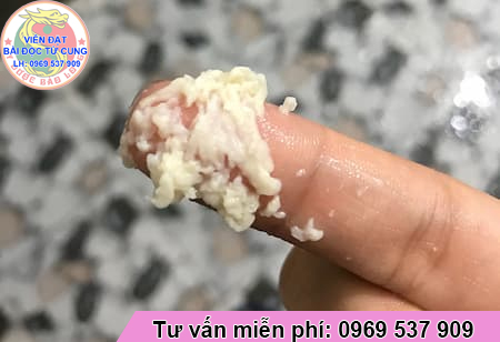 viêm nhiễm phụ khoa do nấm