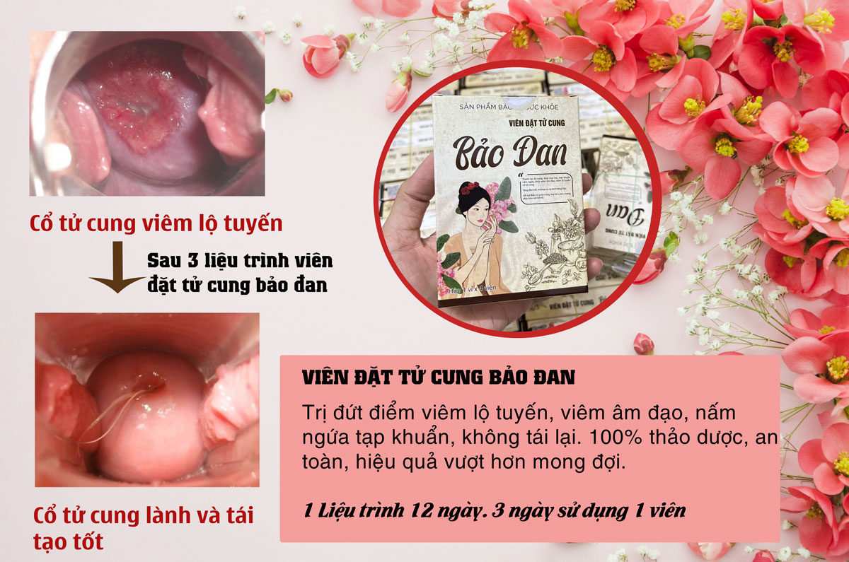 viem lo tuyen